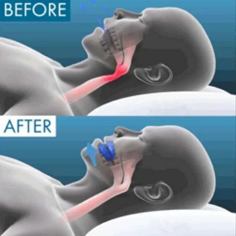 2026 New model Anti Snoring Mouthpiece Reusable Snore Stoppers Sleep Difficulty Snore Stoppers Solution Comfort & Easy Breathing