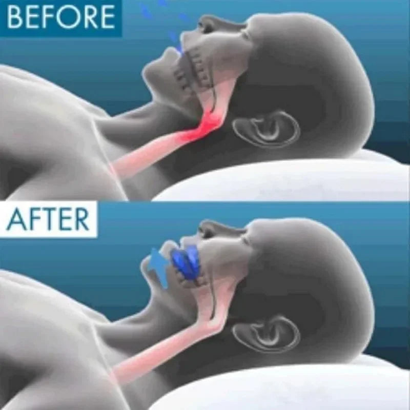 2026-2pcsmodel Anti Snoring Mouthpiece Reusable Snore Stoppers Sleep Difficulty Snore Stoppers Solution Comfort & Easy Breathing